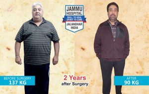 Bariatric Surgery Results at Jammu Hospital Jalandhar