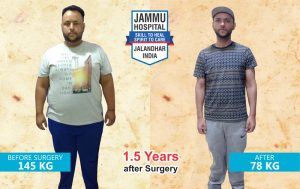 Bariatric Surgery Results at Jammu Hospital Jalandhar
