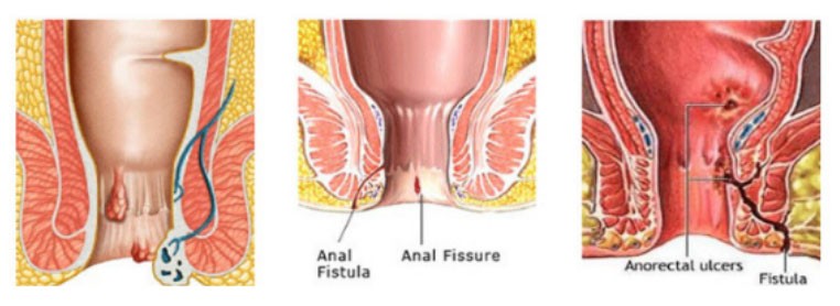 Anal Fissure Laser Surgery in Jalandhar Punjab