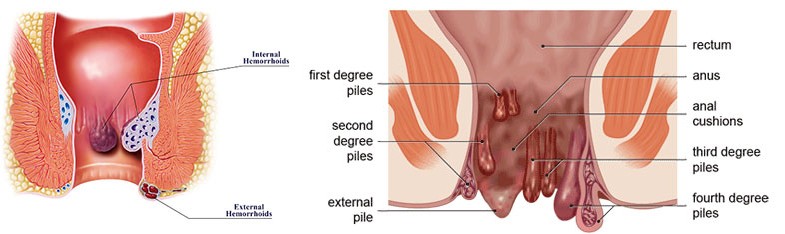 Hemorrhoids (Piles) Laser Surgery in Jalandhar Punjab