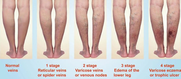 Varicose Veins Laser Surgery in Jalandhar Punjab