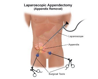 Laparoscopic Appendix Removal Jalandhar Punjab