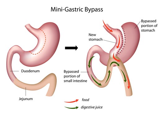 Mini Gastric Bypass Surgery Jalandhar Punjab