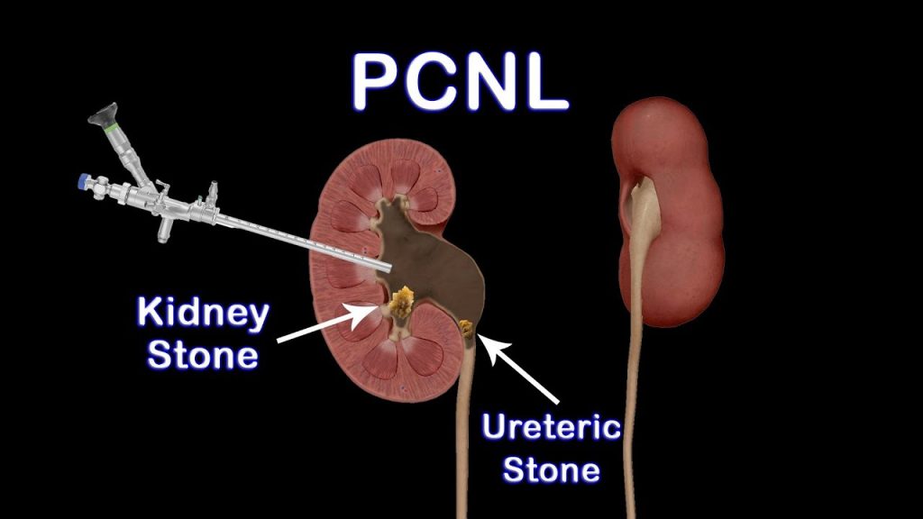 ureteric stone surgery jalandhar punjab