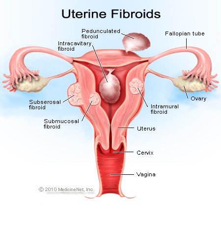 Uterine Fibroids Surgery Jalandhar Punjab