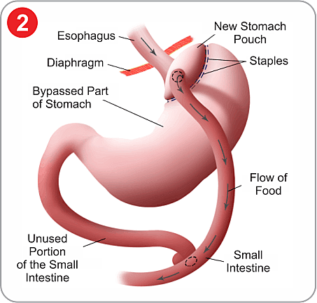 Laparoscopic Gastric Sleeve Resection