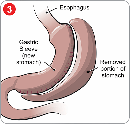 Roux-en-Y Gastric Bypass