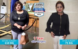 bariatric surgery india results