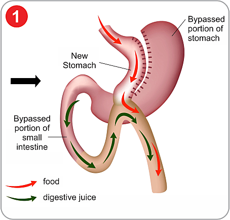 Mini Gastric Bypass Surgery in India