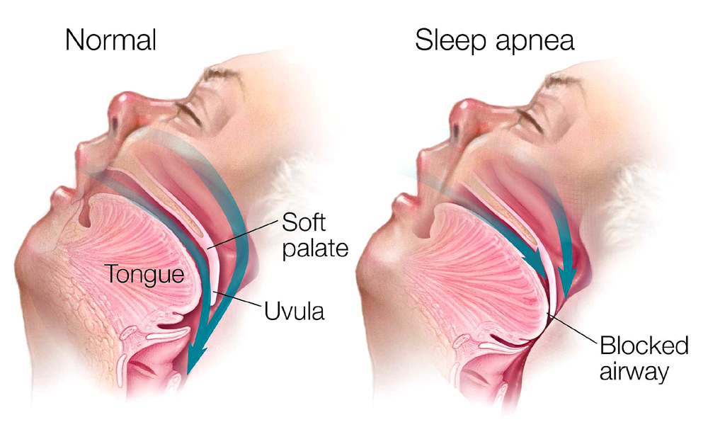 obstructive sleep apnea in punjab